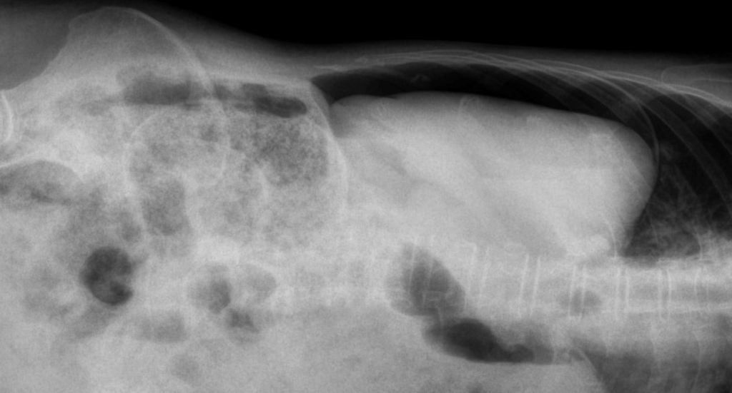 Comment détecter la présence d’un pneumopéritoine lors d’un examen ?